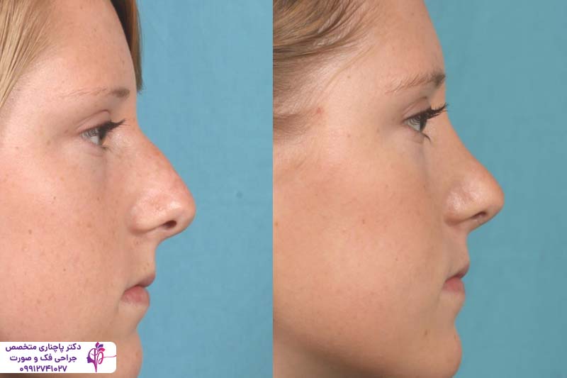 رینوپلاستی نیمه فانتزی