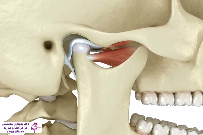 علت تریسموس بعد از جراحی دندان عقل