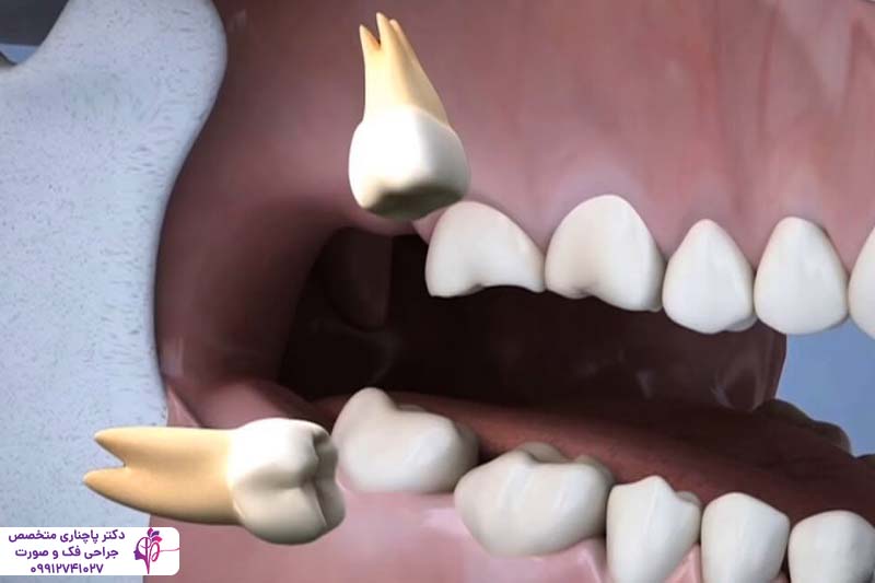 جراحی دندان عقل