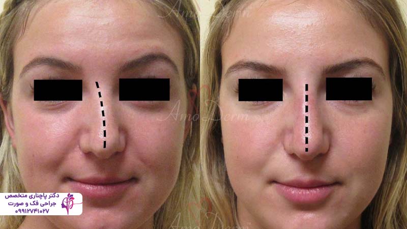 رینوپلاستی بدون جراحی