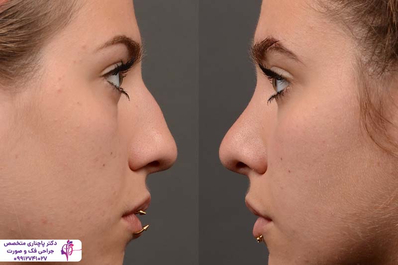 رینوپلاستی نیمه فانتزی