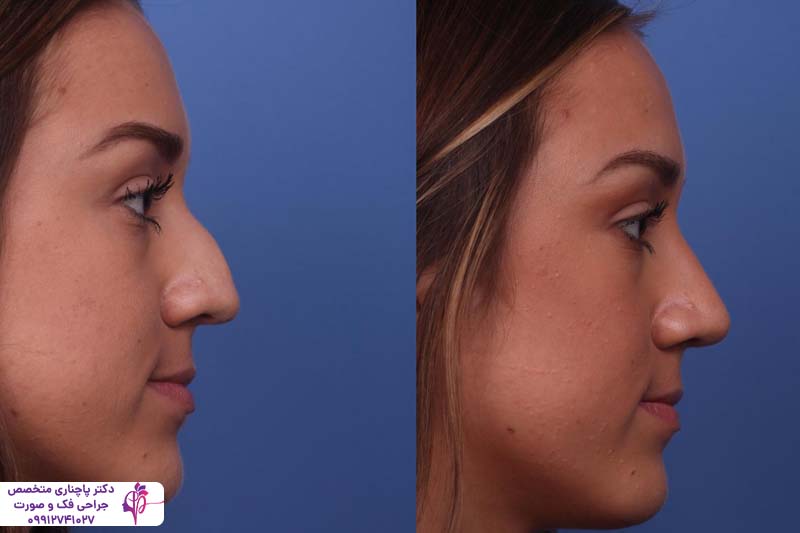 رینوپلاستی نیمه فانتزی