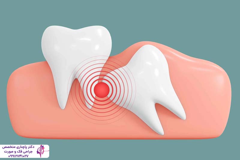 جراحی دندان عقل
