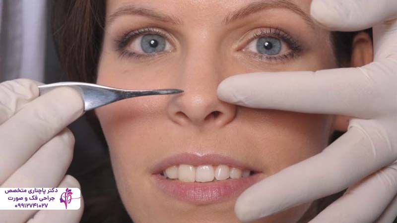 رینوپلاستی بدون جراحی