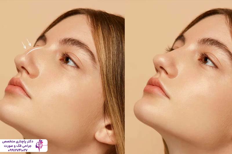 رینوپلاستی نیمه فانتزی