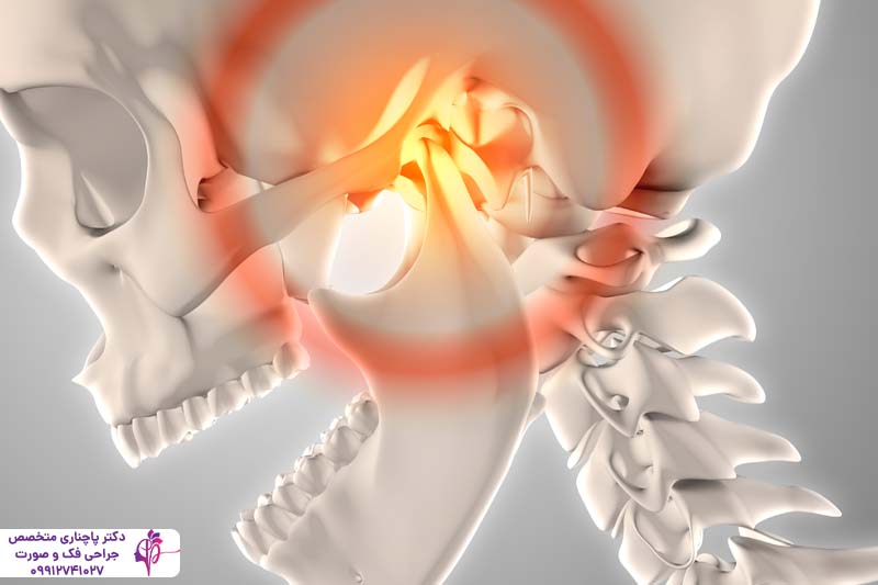 علت تریسموس بعد از جراحی دندان عقل