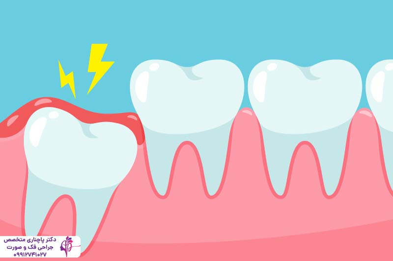 جراحی دندان عقل
