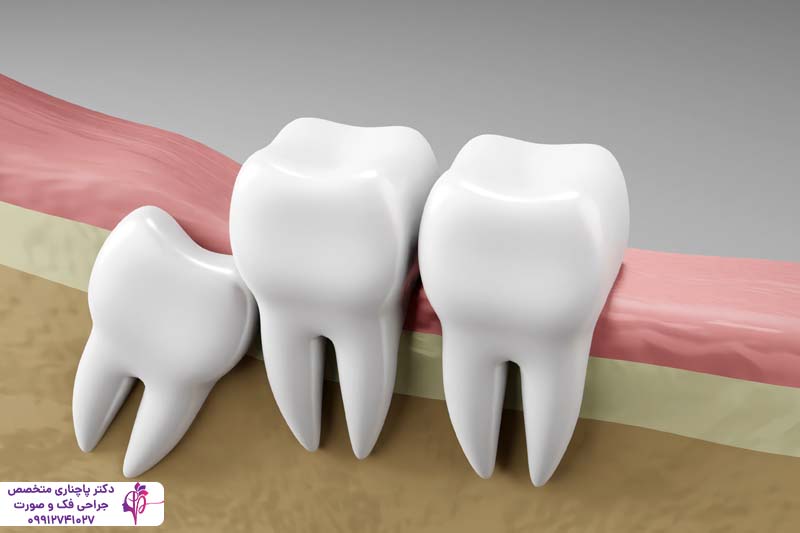 جراحی دندان عقل