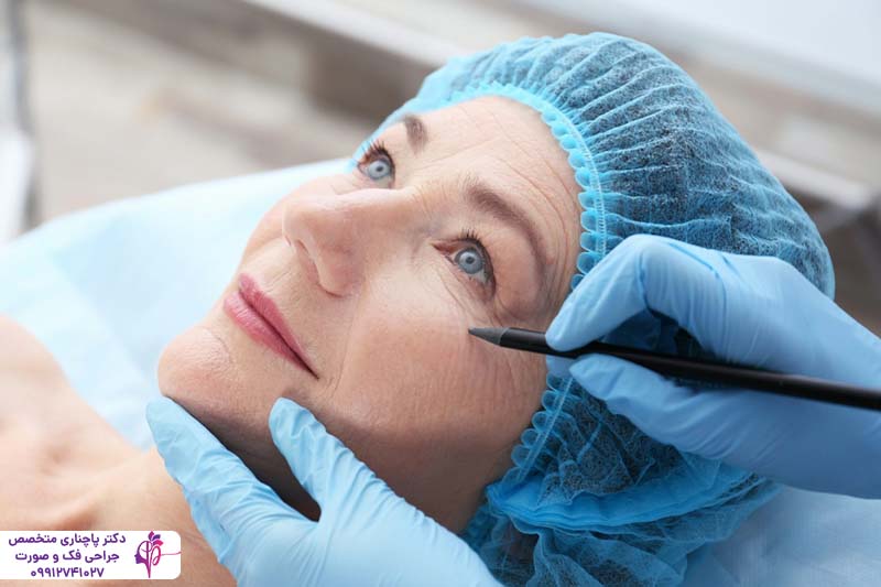 مراقبت‌های بعد از بلفاروپلاستی