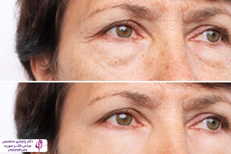 مراقبت‌های بعد از بلفاروپلاستی