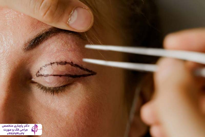 مراقبت‌های بعد از بلفاروپلاستی