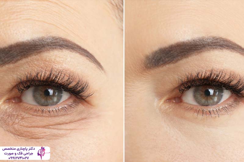 مراقبت‌های بعد از بلفاروپلاستی