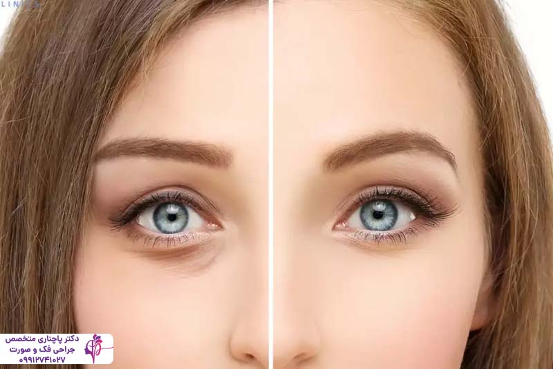 مراقبت‌های بعد از بلفاروپلاستی