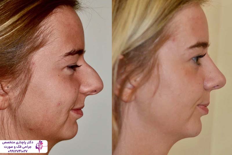 عمل بینی برای چه کسانی خطرناک است