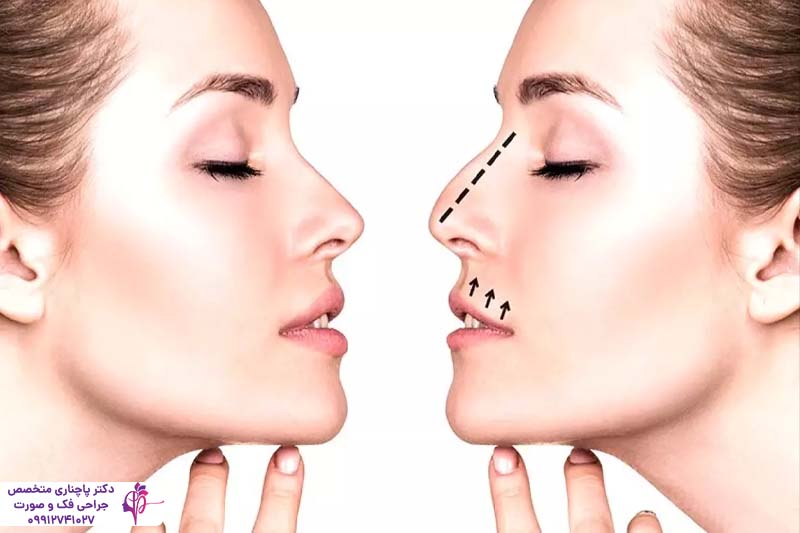 عمل بینی برای چه کسانی خطرناک است