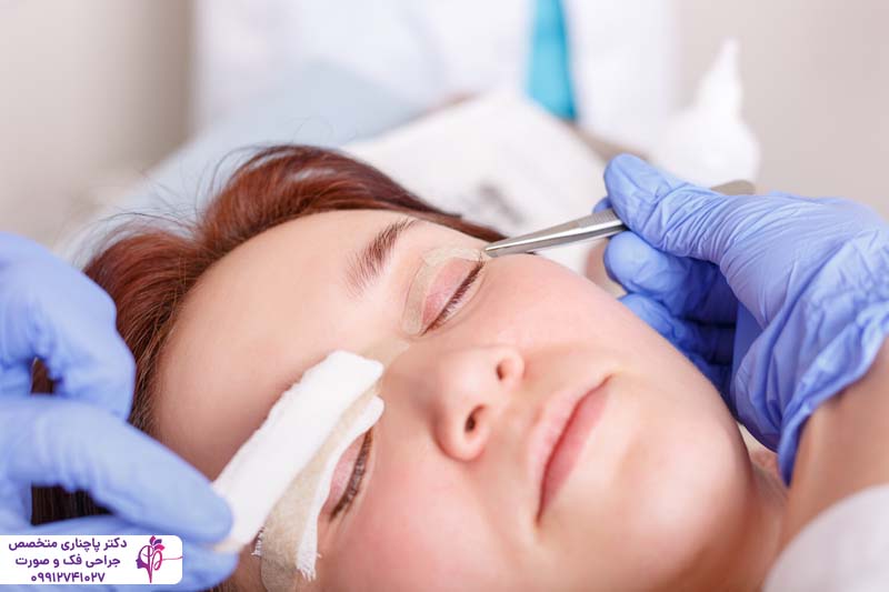 مراقبت‌های بعد از بلفاروپلاستی