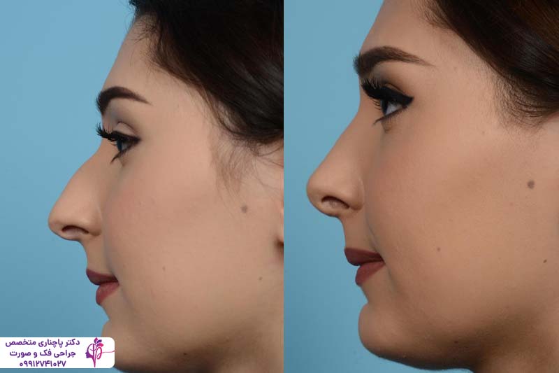 عمل بینی برای چه کسانی خطرناک است