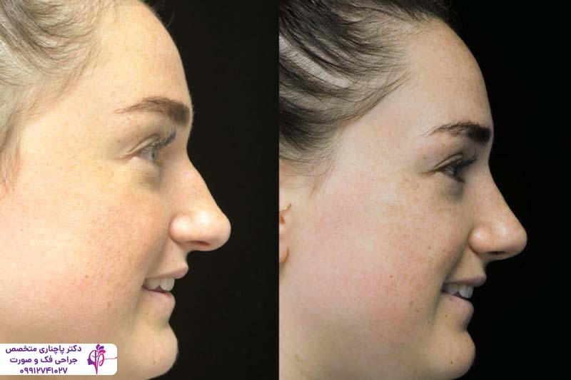 عمل بینی برای چه کسانی خطرناک است