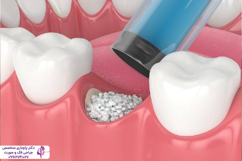 مراقبتهای بعد از پیوند استخوان فک