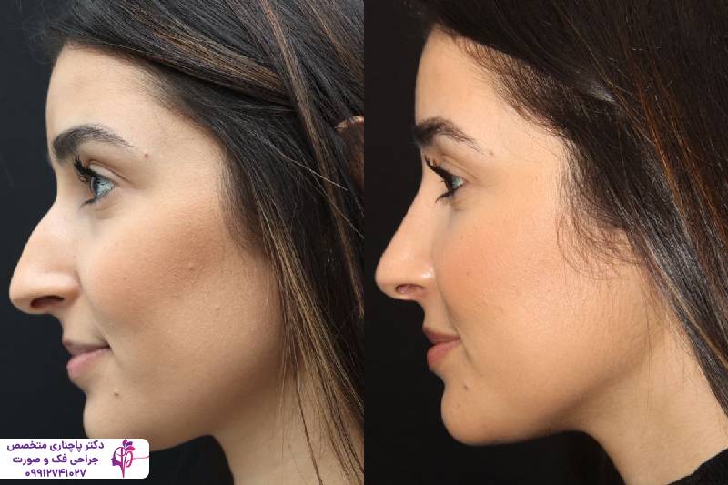 عمل بینی عروسکی یا فانتزی