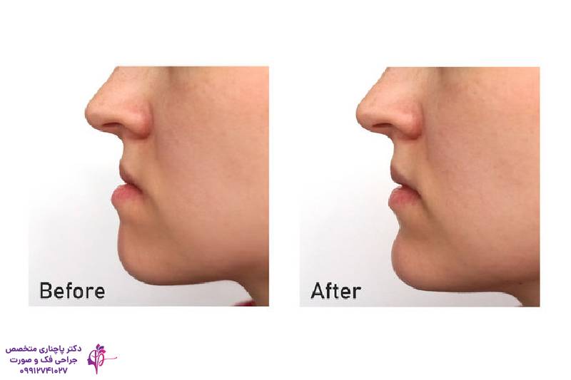 تفاوت جنیوپلاستی و ارتوگناتیک