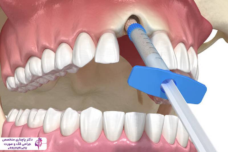 مراقبتهای بعد از پیوند استخوان فک
