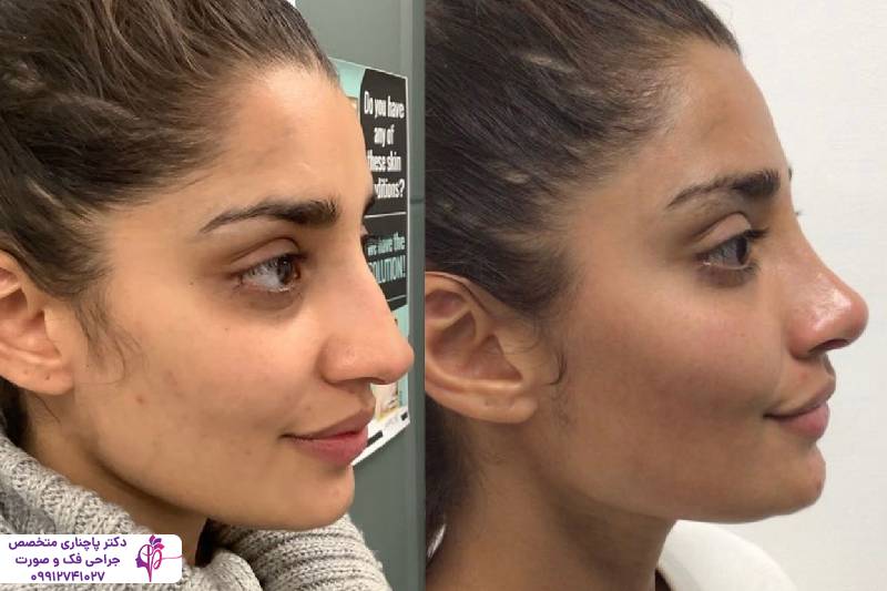 عمل بینی عروسکی یا فانتزی