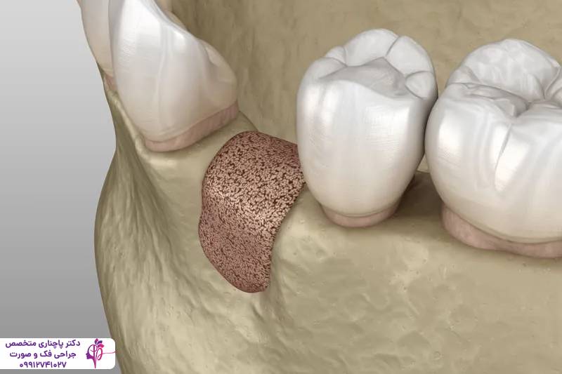 مراقبتهای بعد از پیوند استخوان فک
