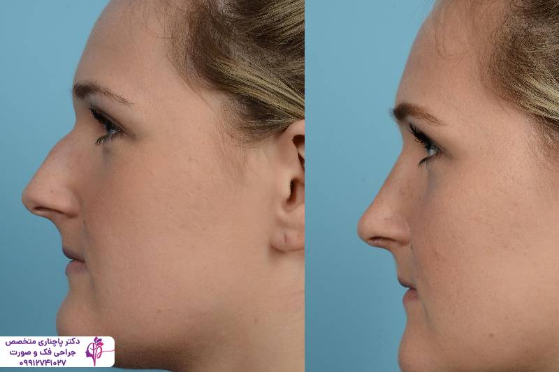 عمل بینی عروسکی یا فانتزی