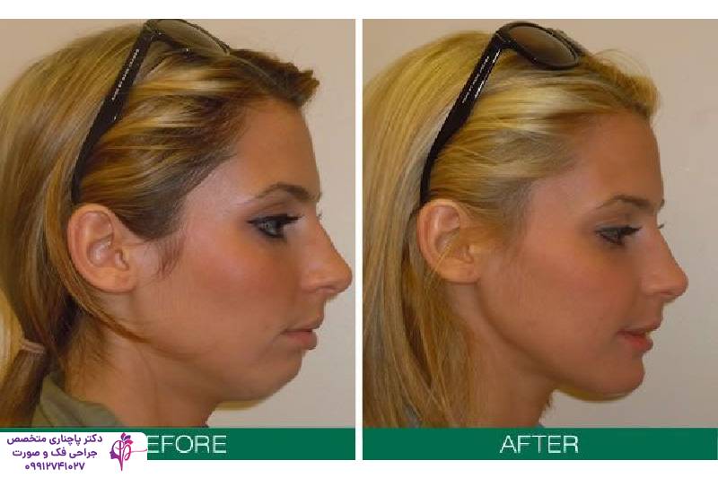 تفاوت جنیوپلاستی و ارتوگناتیک