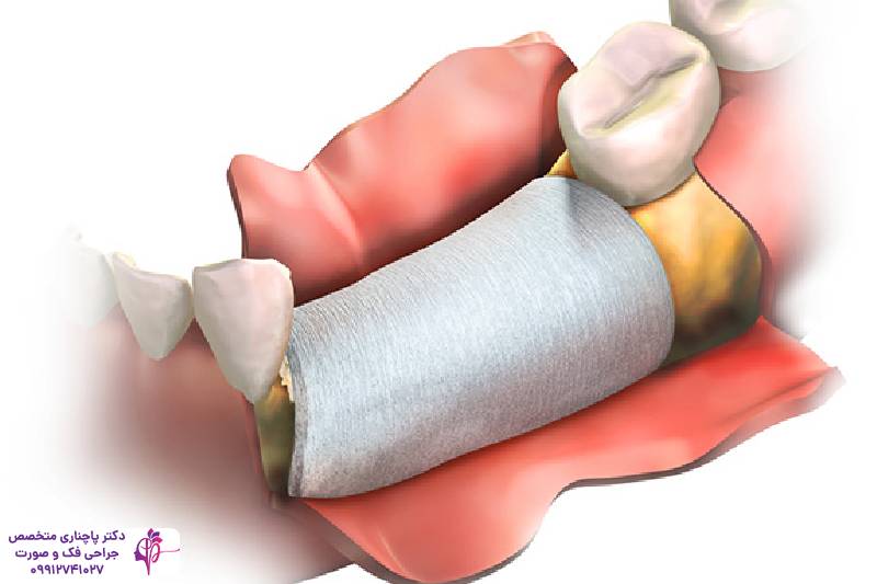 مراقبتهای بعد از پیوند استخوان فک