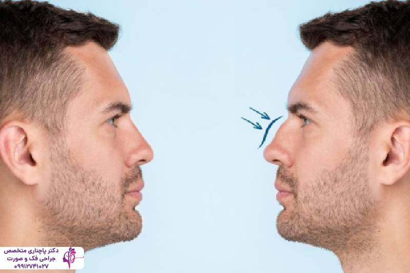 عمل بینی به روش پیزوسرجری