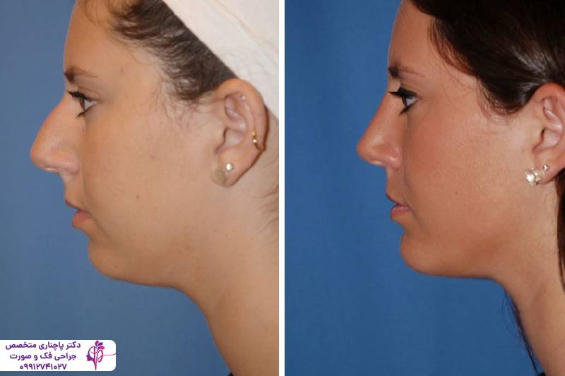 تفاوت جنیوپلاستی و ارتوگناتیک