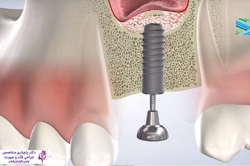 مراقبتهای بعد از پیوند استخوان فک