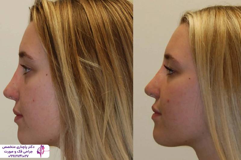 عمل بینی به روش پیزوسرجری