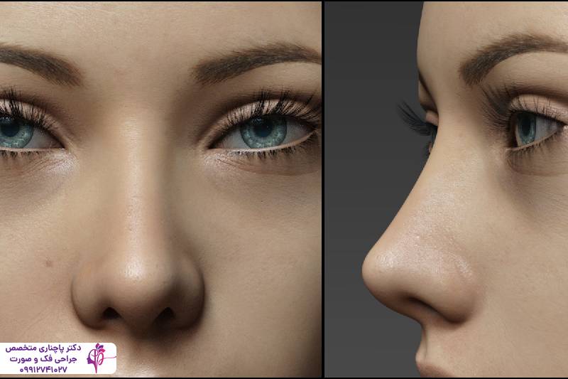 عمل بینی عروسکی یا فانتزی