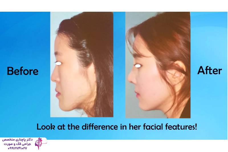 تفاوت جنیوپلاستی و ارتوگناتیک