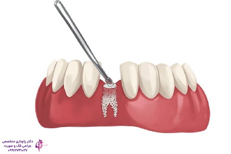 مراقبتهای بعد از پیوند استخوان فک