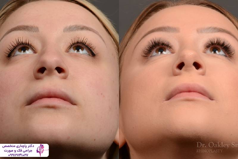 عمل بینی عروسکی یا فانتزی