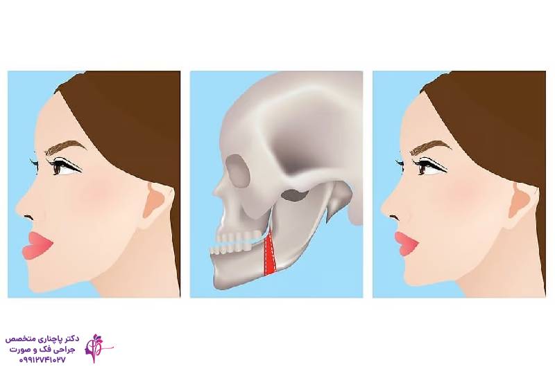 تفاوت جنیوپلاستی و ارتوگناتیک