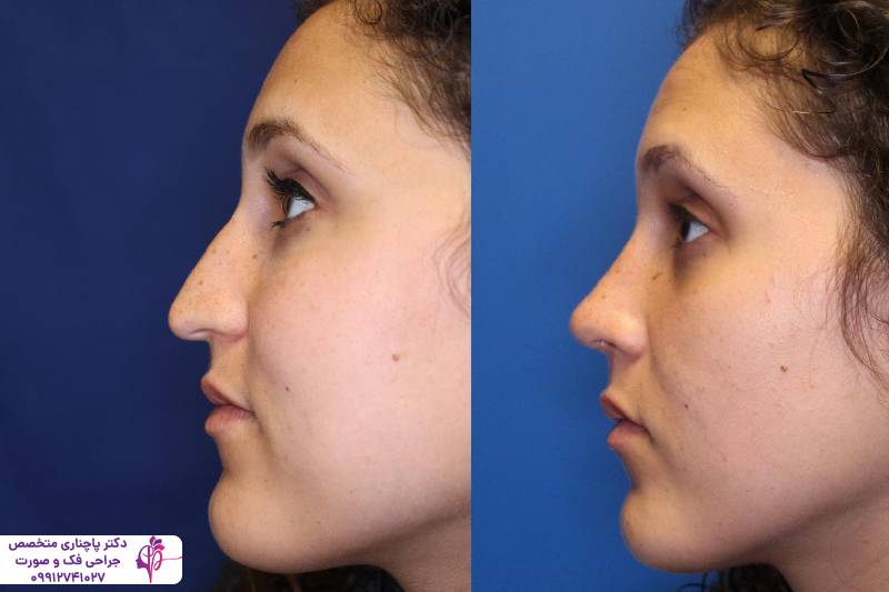 عمل بینی به روش پیزوسرجری