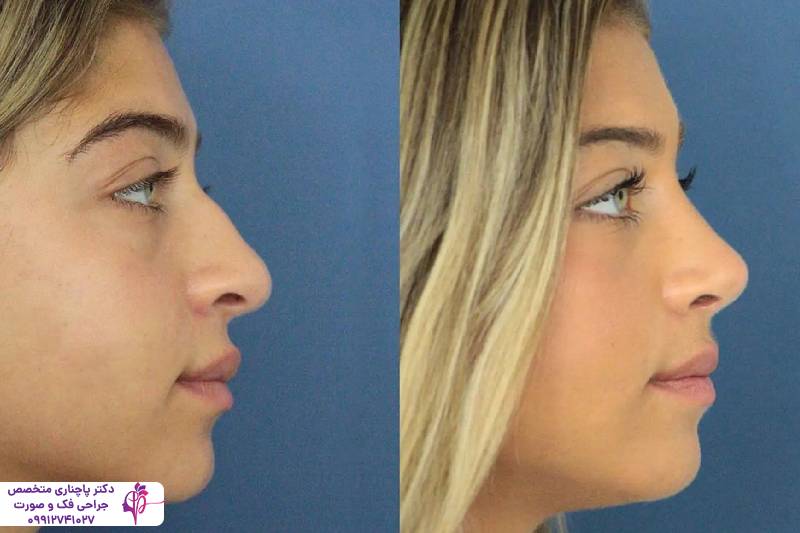 عمل بینی عروسکی یا فانتزی