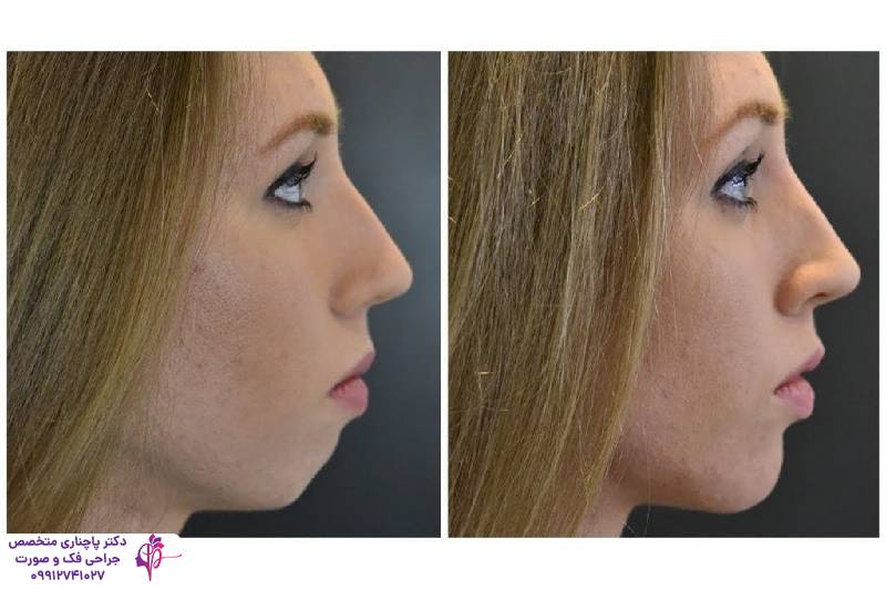 تفاوت جنیوپلاستی و ارتوگناتیک