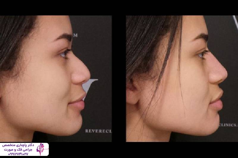 عمل بینی به روش پیزوسرجری