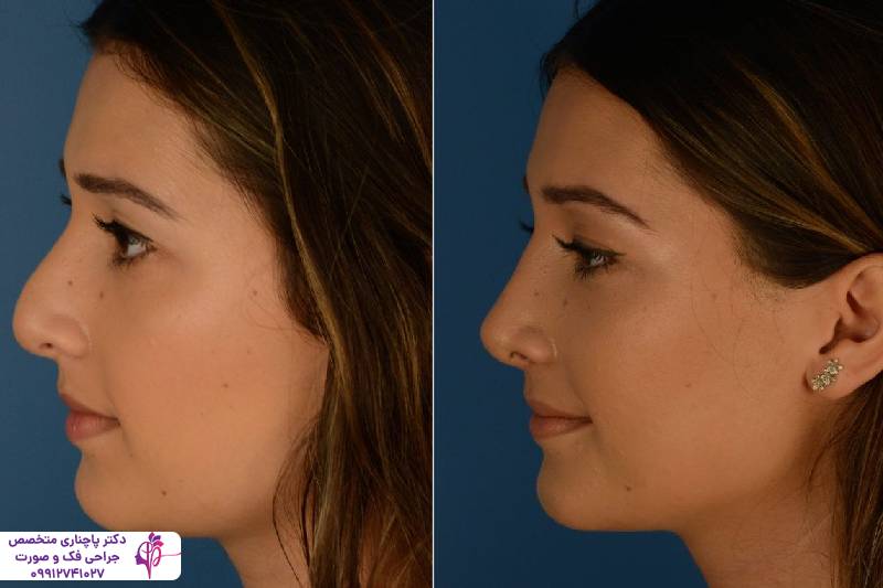 عمل بینی عروسکی یا فانتزی