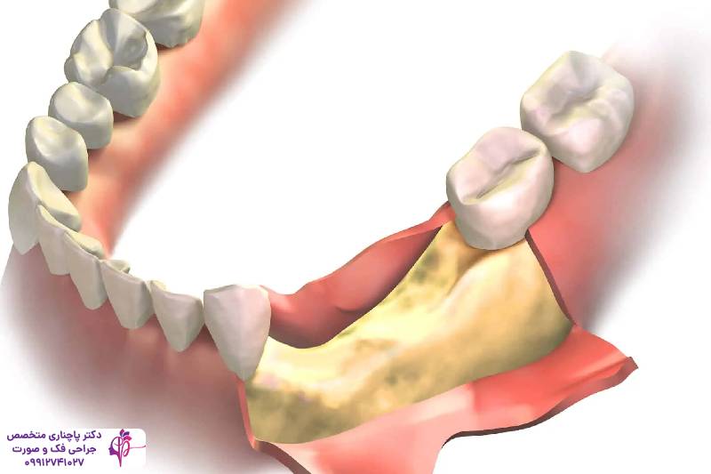 مراقبتهای بعد از پیوند استخوان فک
