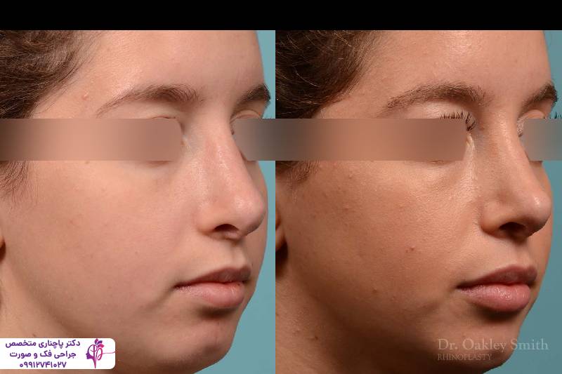 عمل بینی به روش پیزوسرجری