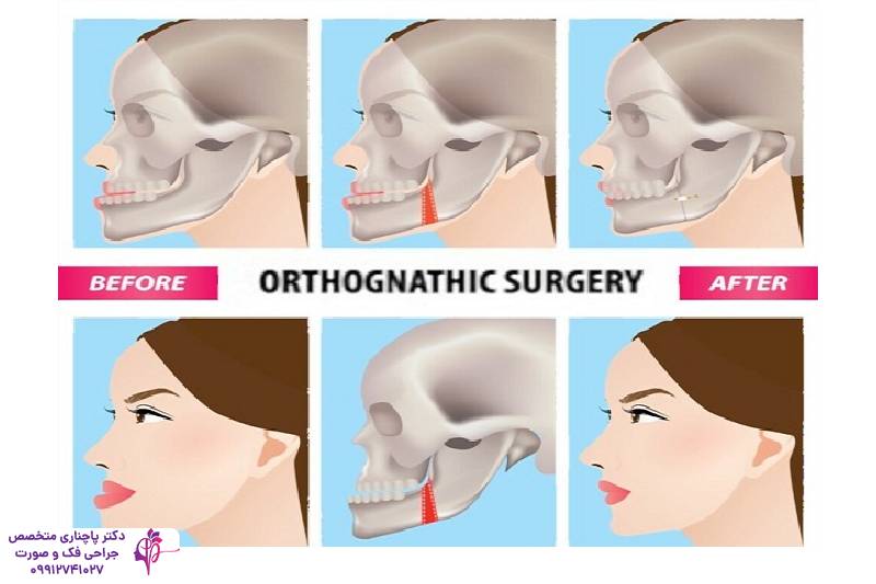 تفاوت جنیوپلاستی و ارتوگناتیک