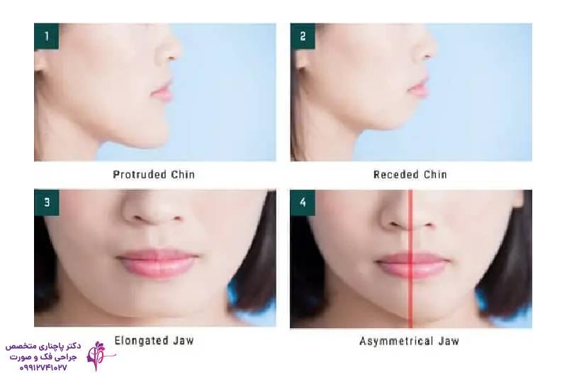 تفاوت جنیوپلاستی و ارتوگناتیک