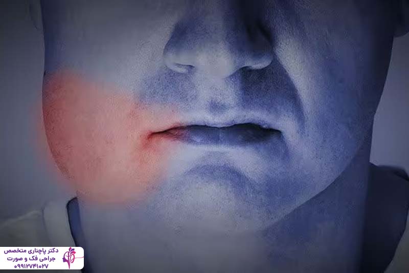 ورم صورت بعد از پیوند استخوان